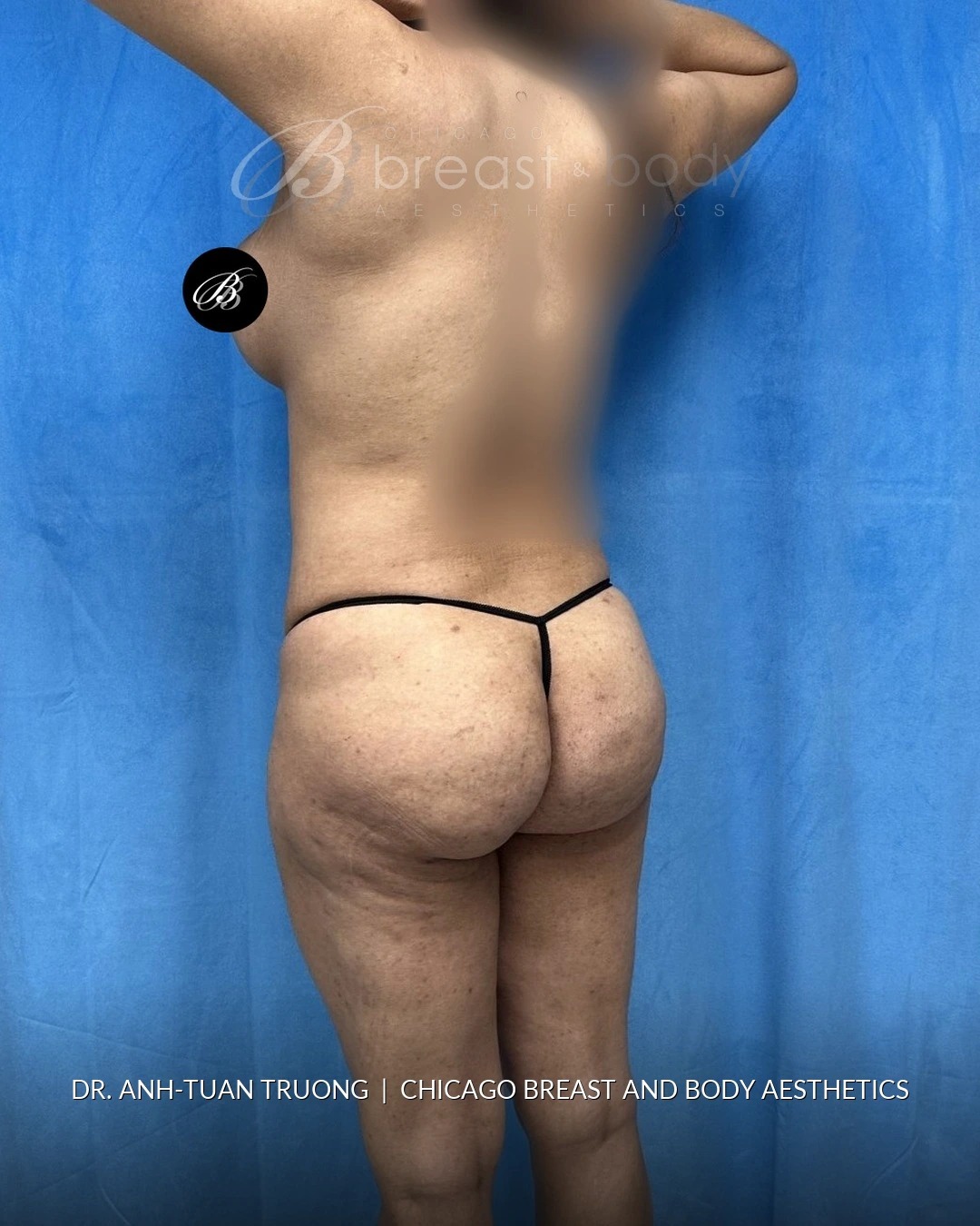 Brazilian Butt Lift, Lipo 360, Hip Augmentation after photo, three-quarter view, case #2358724, Dr. Anh-Tuan Truong, Chicago Breast & Body