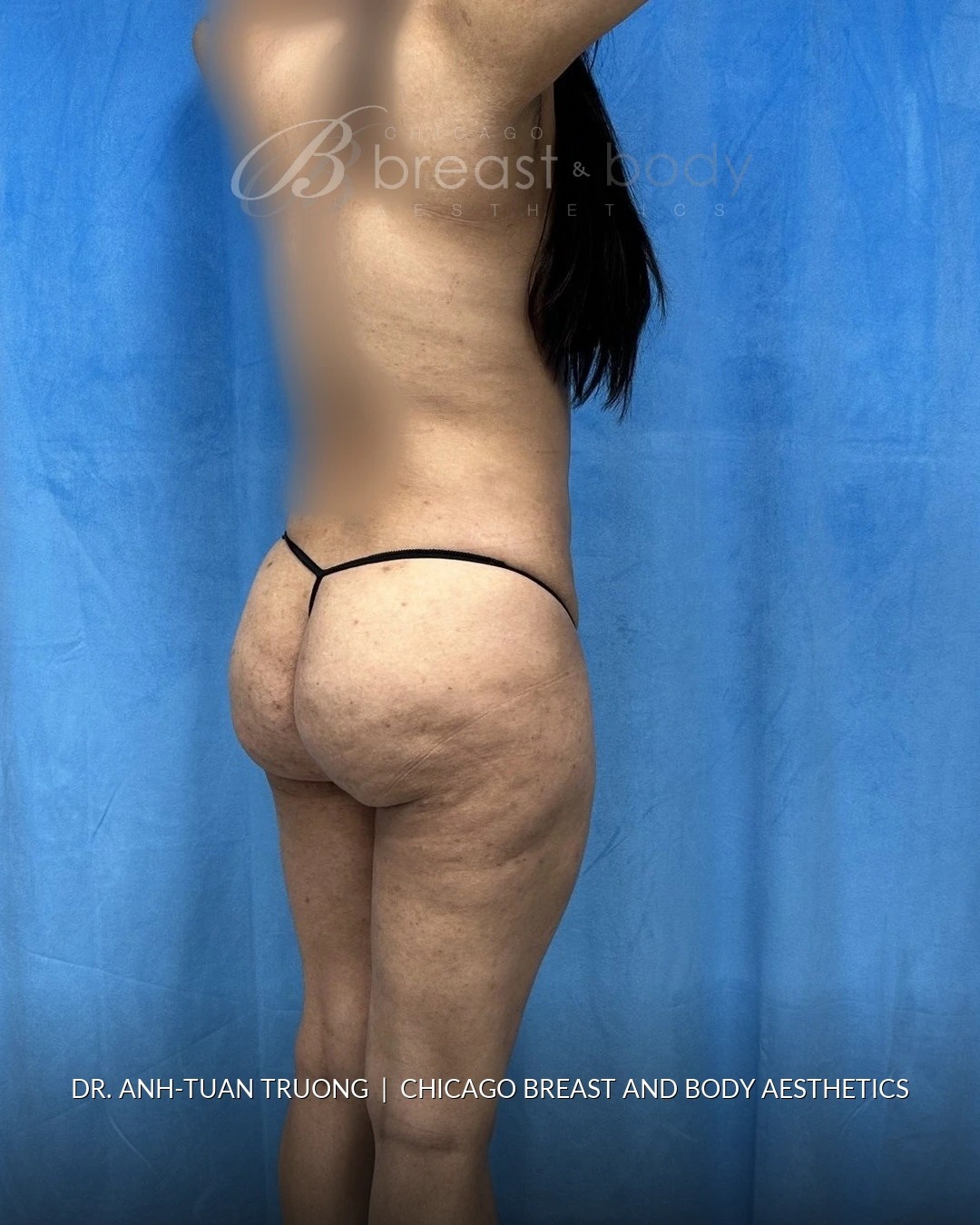Brazilian Butt Lift, Lipo 360, Hip Augmentation after photo, three-quarter view, case #2358724, Dr. Anh-Tuan Truong, Chicago Breast & Body