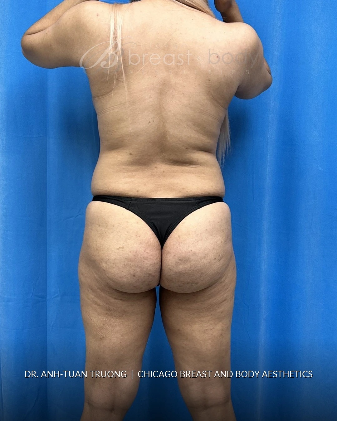 Brazilian Butt Lift, Lipo 360, Hip Augmentation before photo, back view, case #2358724, Dr. Anh-Tuan Truong, Chicago Breast & Body