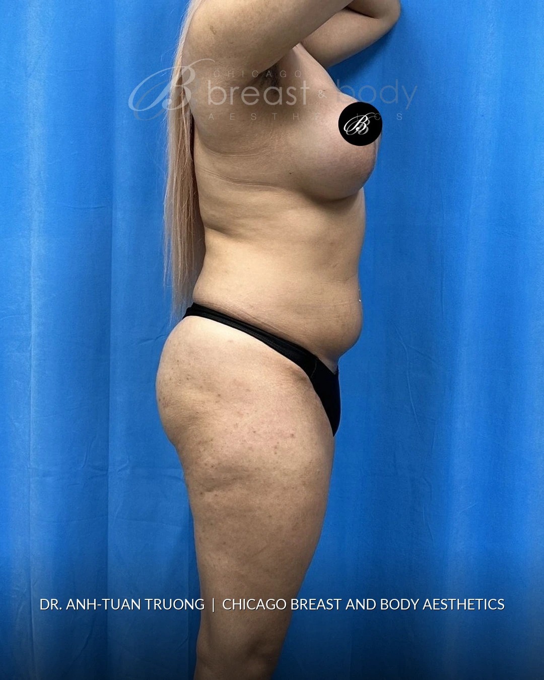 Brazilian Butt Lift, Lipo 360, Hip Augmentation before photo, side view, case #2358724, Dr. Anh-Tuan Truong, Chicago Breast & Body