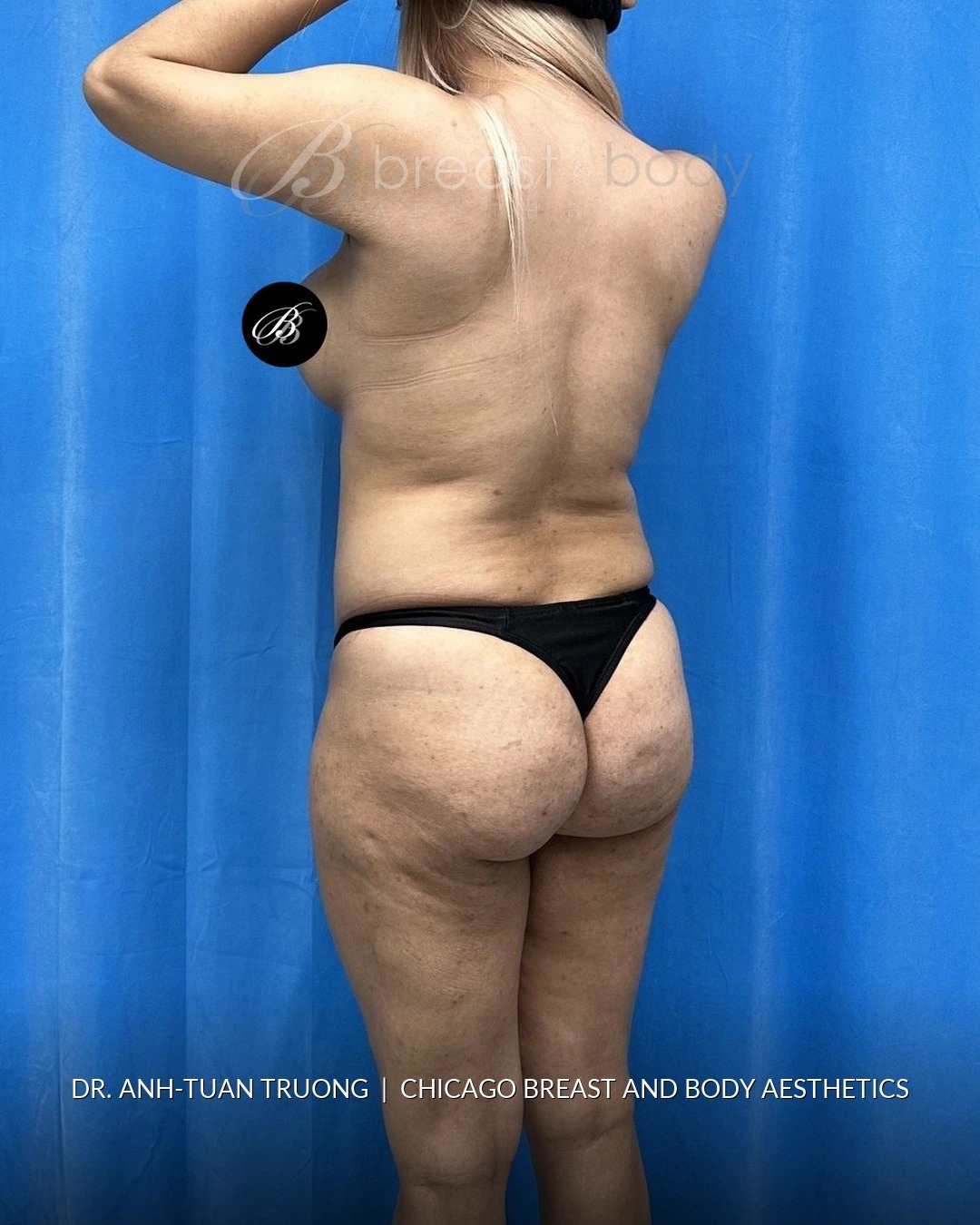 Brazilian Butt Lift, Lipo 360, Hip Augmentation before photo, three-quarter view, case #2358724, Dr. Anh-Tuan Truong, Chicago Breast & Body
