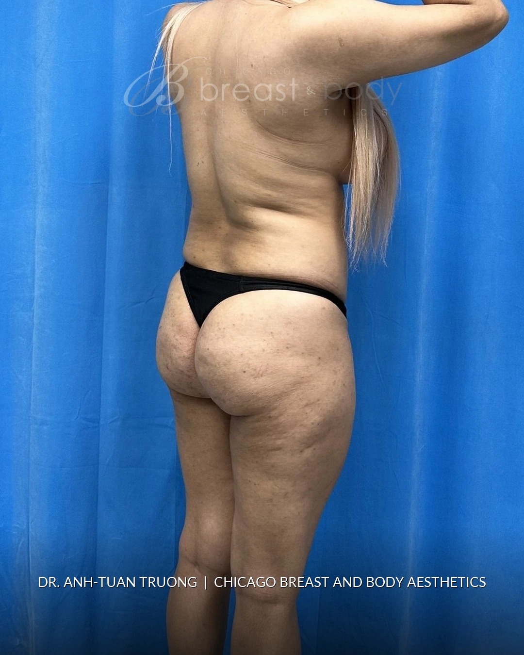 Brazilian Butt Lift, Lipo 360, Hip Augmentation before photo, three-quarter view, case #2358724, Dr. Anh-Tuan Truong, Chicago Breast & Body