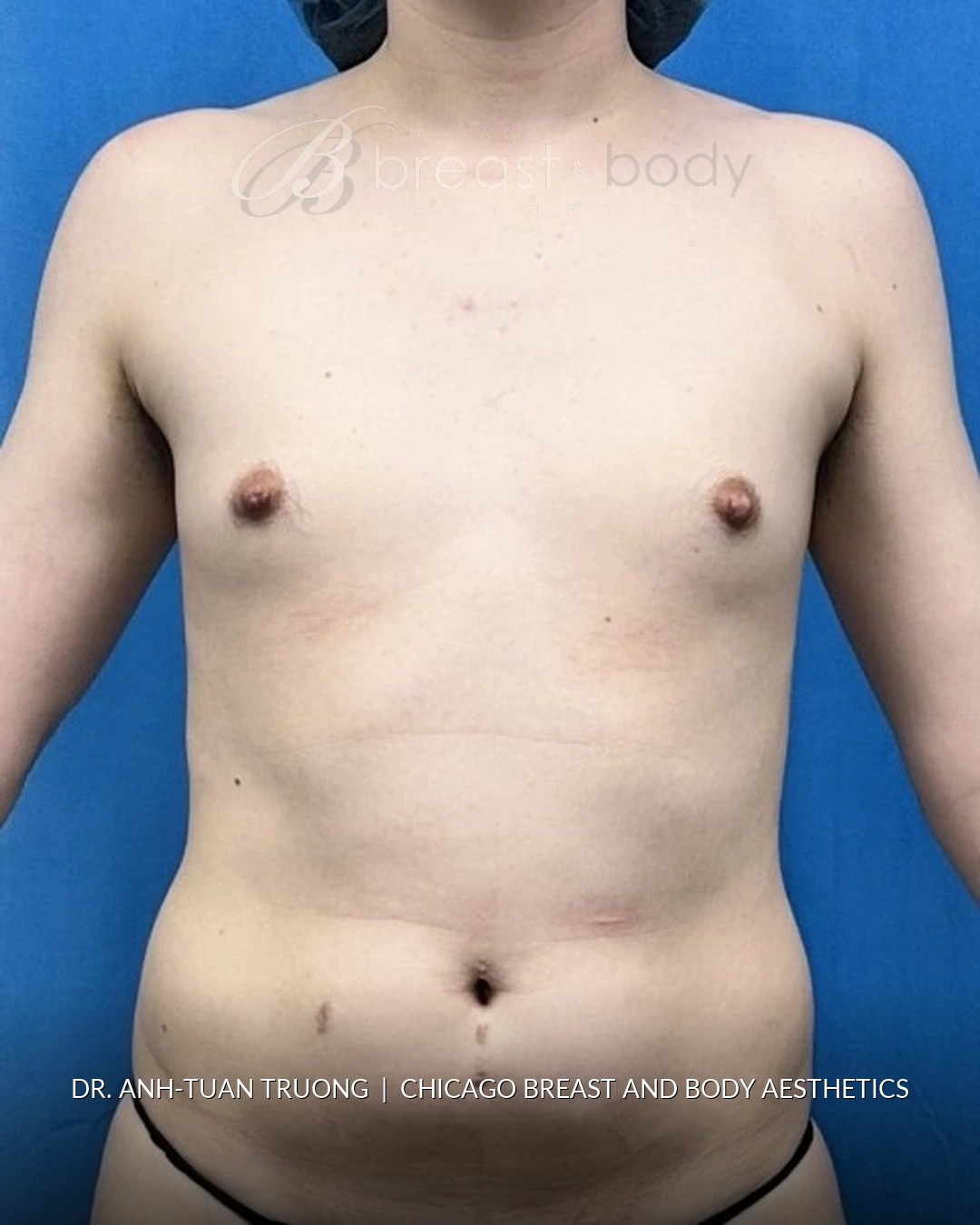 Breast Augmentation, Gender-Affirming Breast Augmentation before photo 1, case #2369745, Dr. Anh-Tuan Truong, Chicago Breast & Body