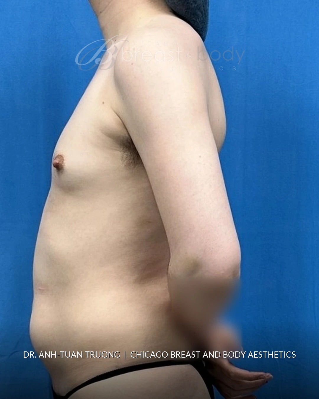 Breast Augmentation, Gender-Affirming Breast Augmentation before photo 3, case #2369745, Dr. Anh-Tuan Truong, Chicago Breast & Body