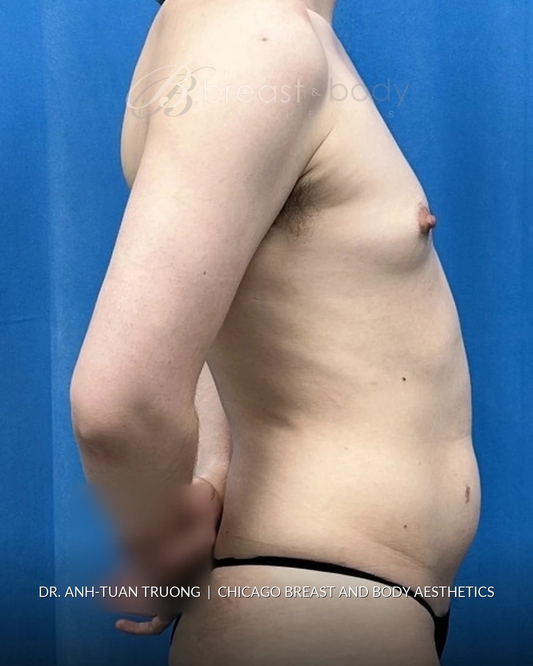 Breast Augmentation, Gender-Affirming Breast Augmentation before photo 4, case #2369745, Dr. Anh-Tuan Truong, Chicago Breast & Body
