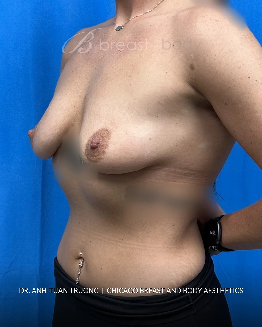 Breast Lift with Implant before photo 2, case #2371922, Dr. Anh-Tuan Truong, Chicago Breast & Body