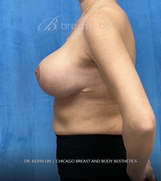 Breast Lift (Mastopexy) after photo, side view, case #2402178, Dr. Kevin Lin, Chicago Breast & Body
