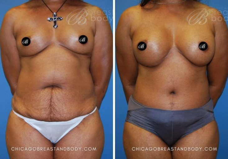 174 Tummy Tuck Dr. Truong Chicago 6mos