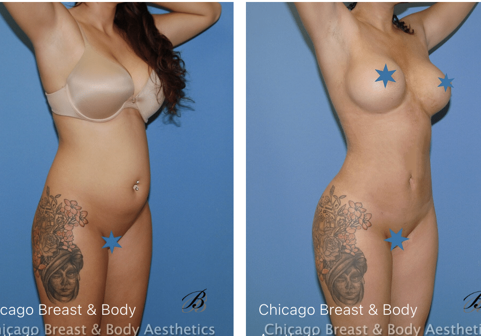 Before after image of liposuction of abdomen