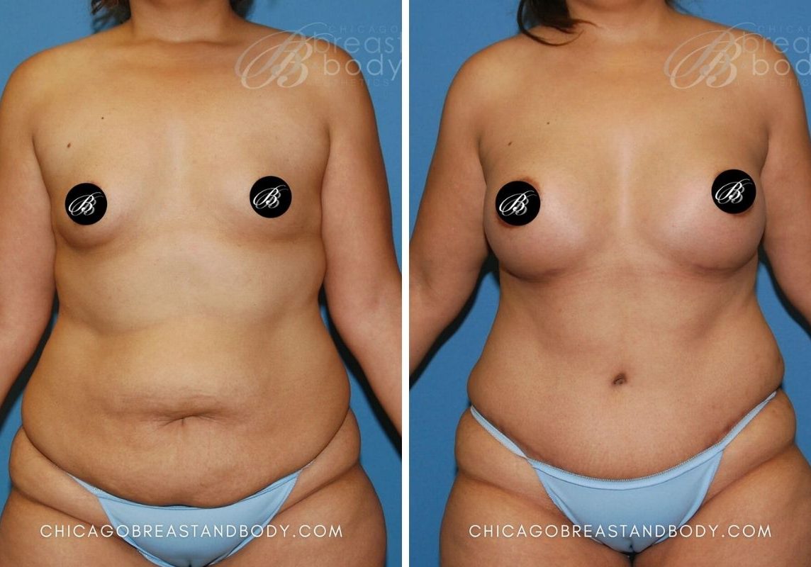 426 Mommy Makeover Dr. Truong Chicago 6mos