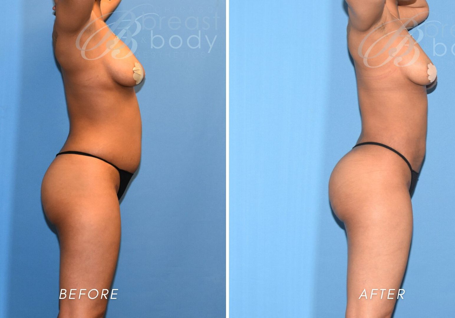 before and after liposuction by dr. anh tuan truong chicago breast and body