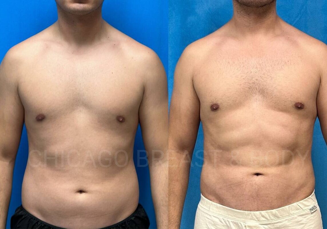 Fat graft to male chest menu image