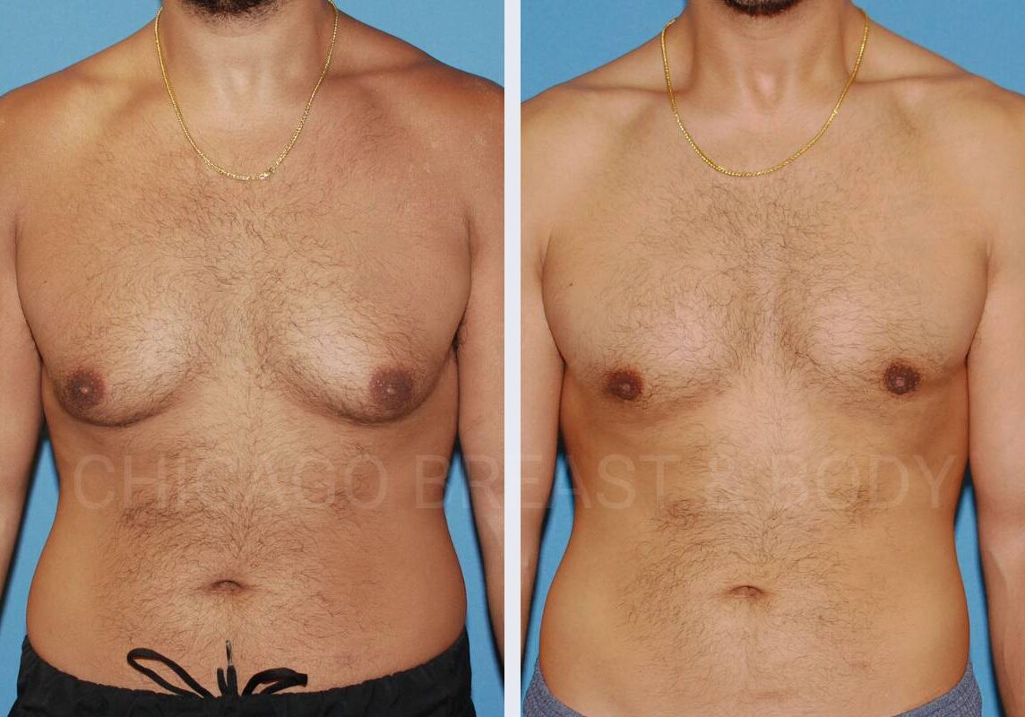 Body contouring before and after - Chicago Breast and Body