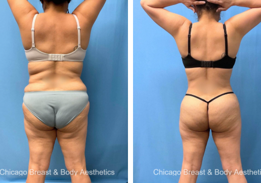 liposuction before after photo chicago breast and body