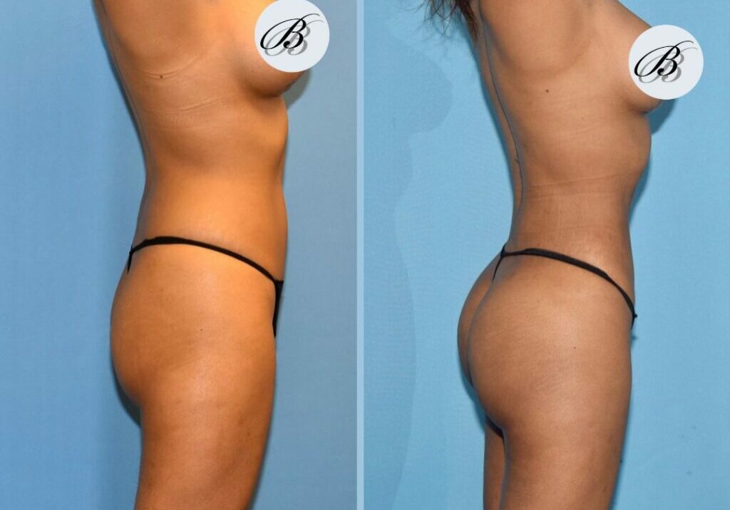 Athletic-BBL-Before-After  Chicago Breast & Body Aesthetics