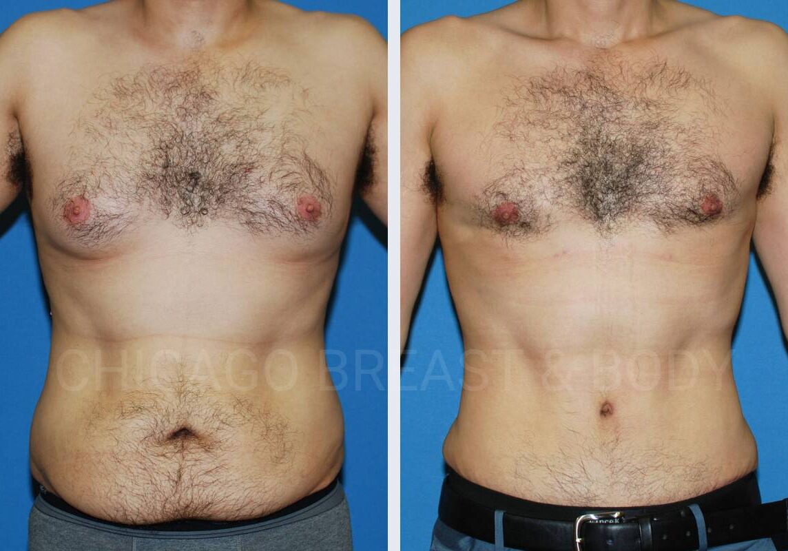 Tummy tuck before and after - Chicago Breast and Body