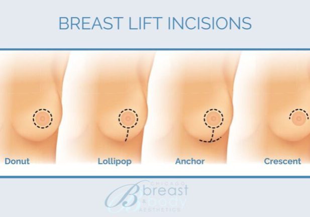 Types of breast lift incisions
