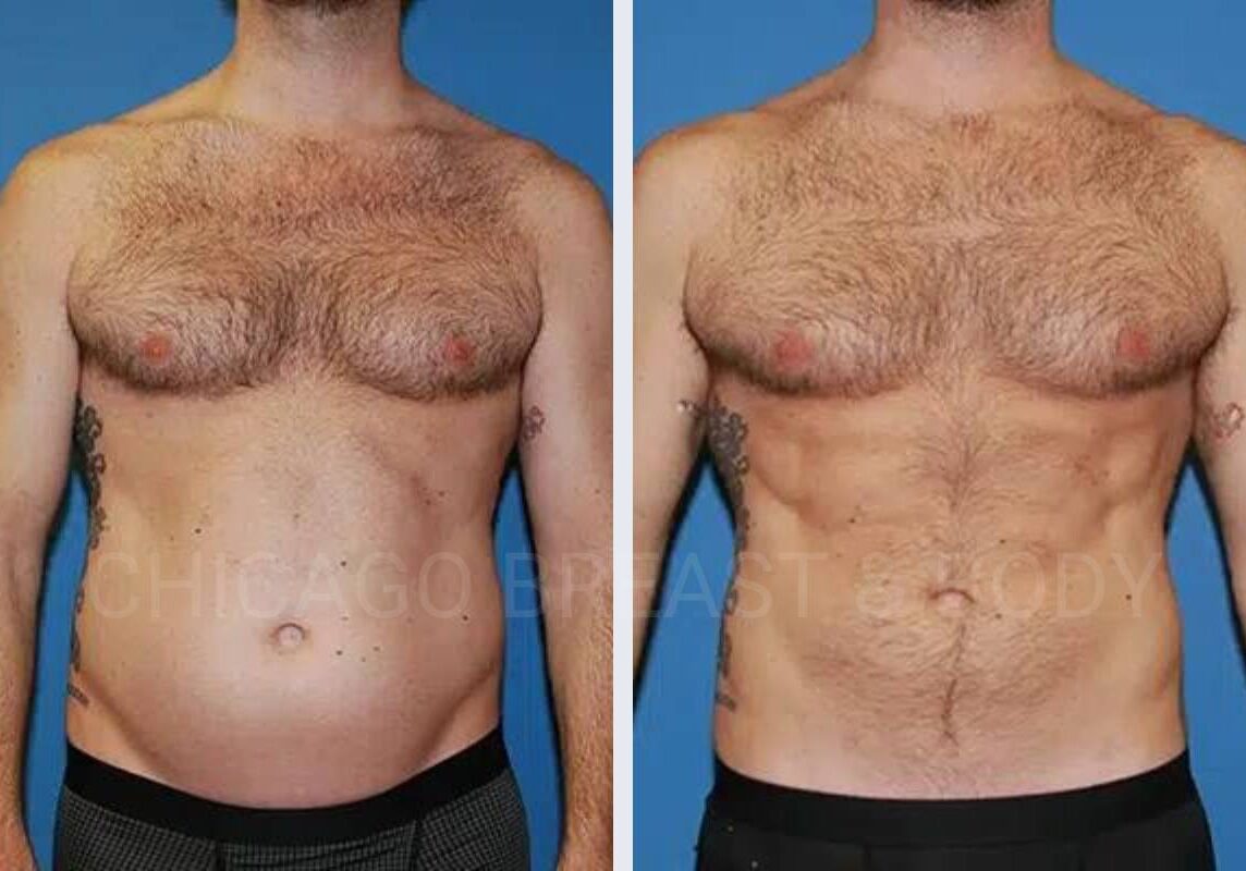 Vaser Ab etching menu image