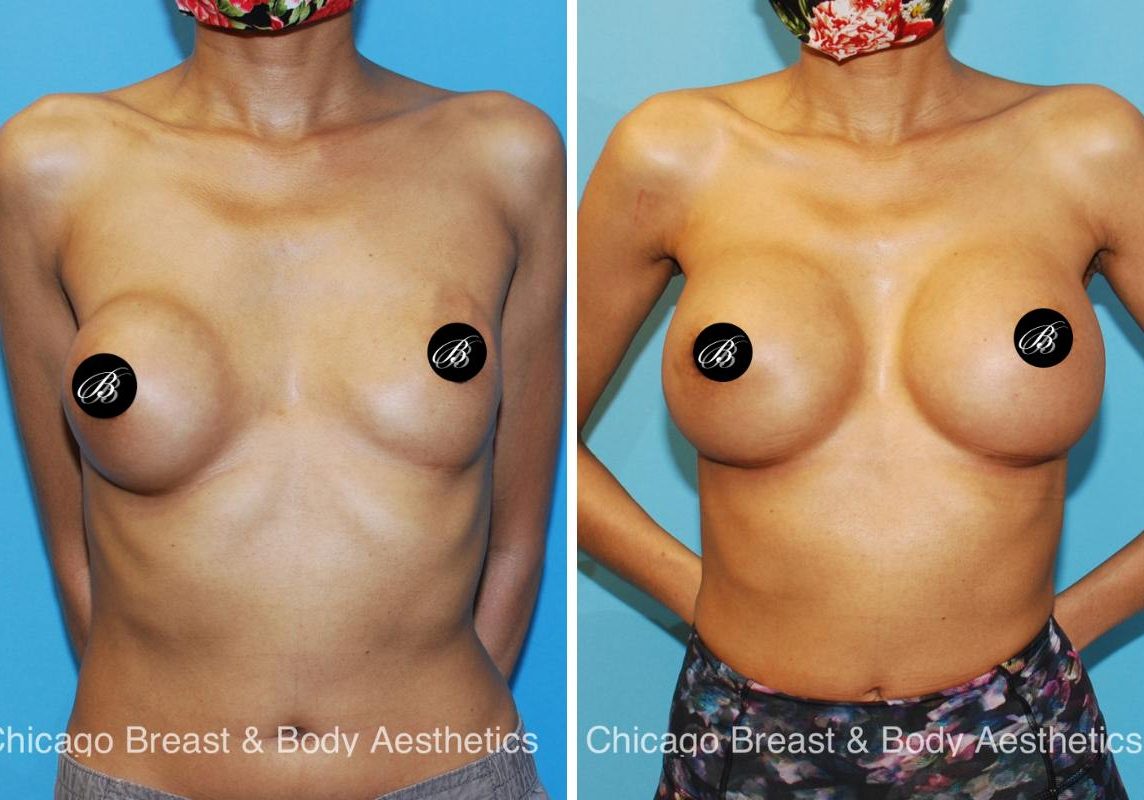 breast implant removal before after by dr truong chicago breast and body