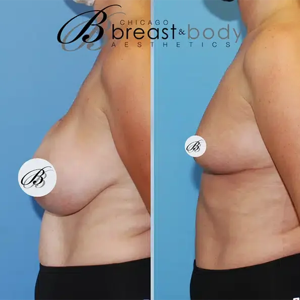 A Woman'S Breast Before And After Breast Implant Remonthval Surgery At Chicago Breast And Body