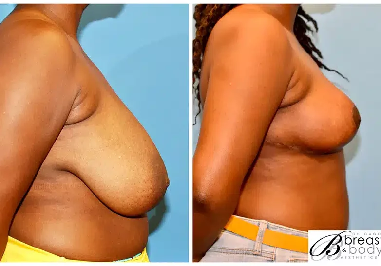 before and after breast lift by Chicago Breast and Body Aesthetics