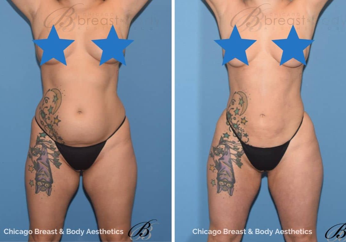 Hip augmentation surgery before and after