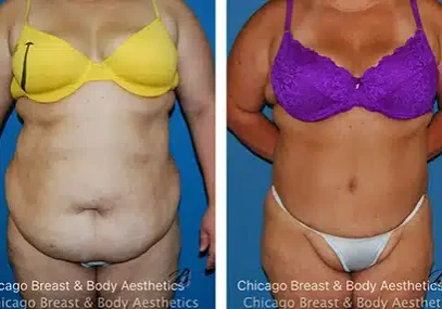plus-size-tummy-tuck-chicago-before-after-photo-case-197 copia