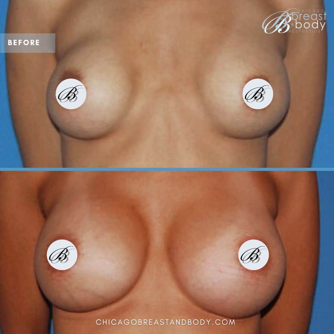should I wait to get breast implants after kids? Chicagobreastandbody.com