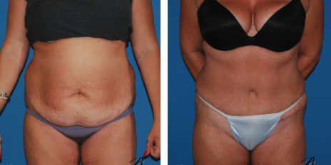 tummy tuck before and after best tummy tuck surgeon chicago - Plastic Surgery FAQ