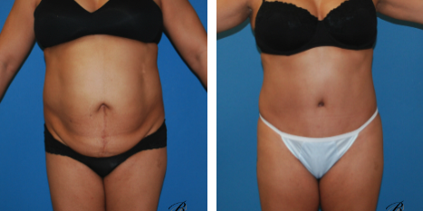 best tummy tuck before and after photos. Chicago Breast and Body Aesthetics - Plastic Surgery FAQ