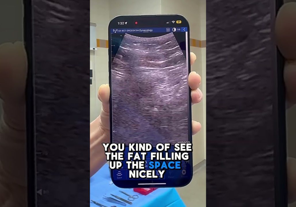 Video Thumbnail: Ultrasound Guided Bbl (Brazilian Butt Lift)