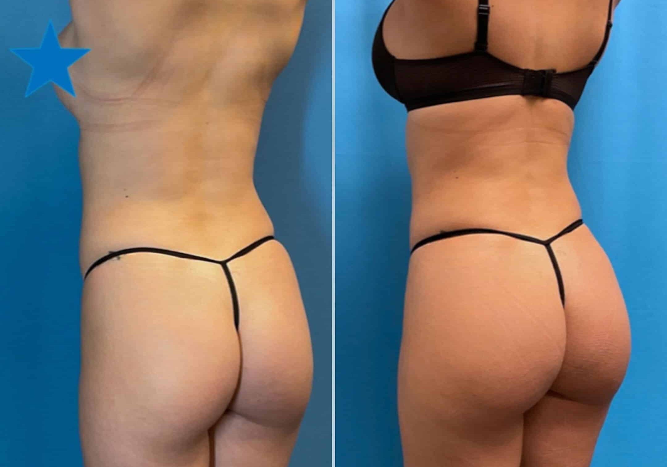 Athletic-BBL-Before-After  Chicago Breast & Body Aesthetics